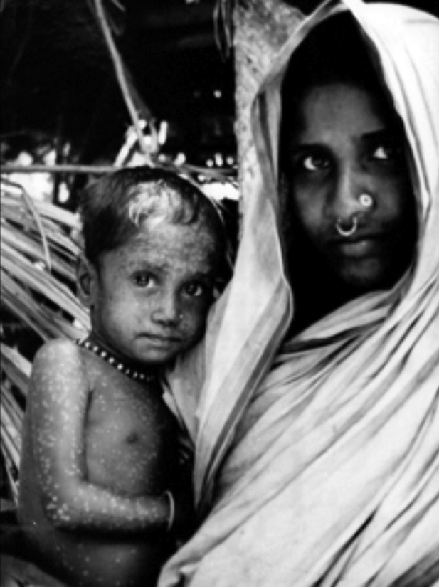 Eradicating Smallpox.